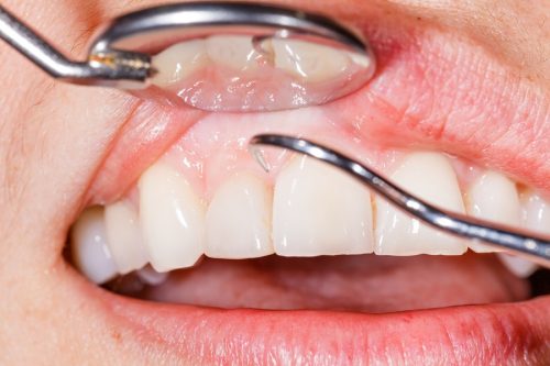 Curso de Especialização em Prótese Dental - Periodontia